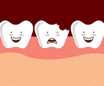 Dental Injuries